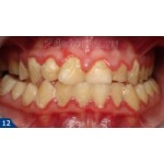 Честные отзывы о Ультразвуковая зубная щетка