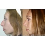 Честные отзывы о Пластика носа