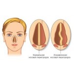Честные отзывы о Септопластика