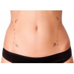 Честные отзывы о Липосакция