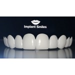 Честные отзывы о Implant Smiles - съемные виниры